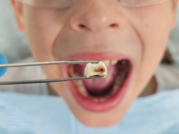 Best Dental Abscess Treatment in Wheaton, MN